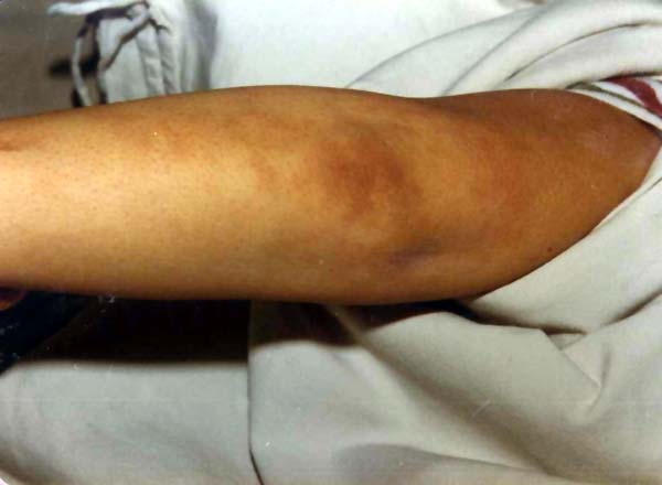 中医望皮肤之结节红斑