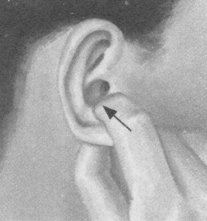 肩周炎按摩部位图解