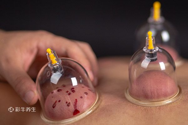拔罐的好处与功效 拔罐有哪些作用