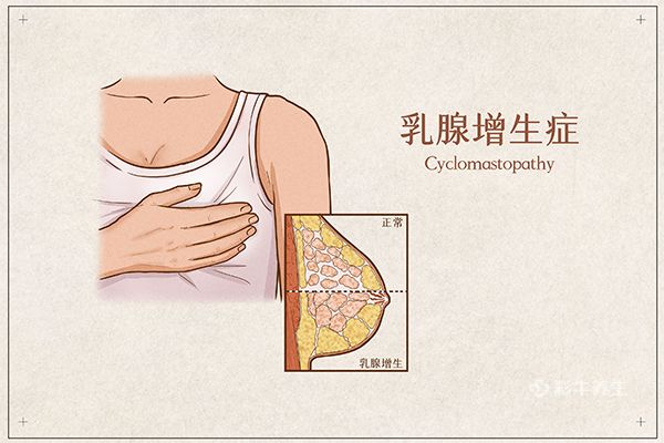乳腺增生怎么治疗最好的方法 乳腺增生怎么治疗最好