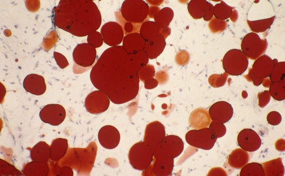 脂肪瘤，是体内痰浊太多了