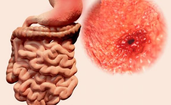 广东饮食清淡，为何却大肠癌高发？多半与4个因素有关，别小觑