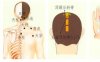 颈椎病刮痧部位图解