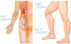 类风湿性关节炎按摩部位图解