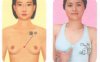 急性乳腺炎按摩部位图解