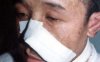 中医望鼻之鼻柱塌陷