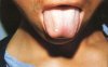 舌疔1