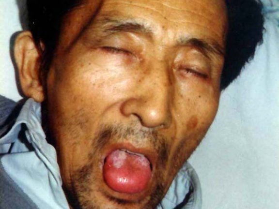 中医望色之恶色(面色黧黑,舌红肿胀)