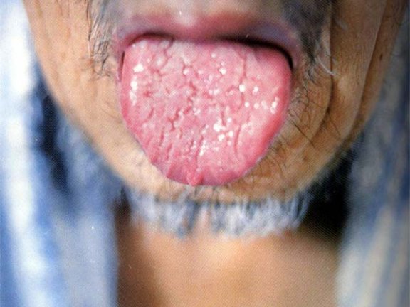 淡紫裂纹舌透明苔