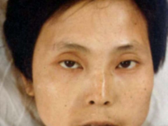 中医望神之重病失神