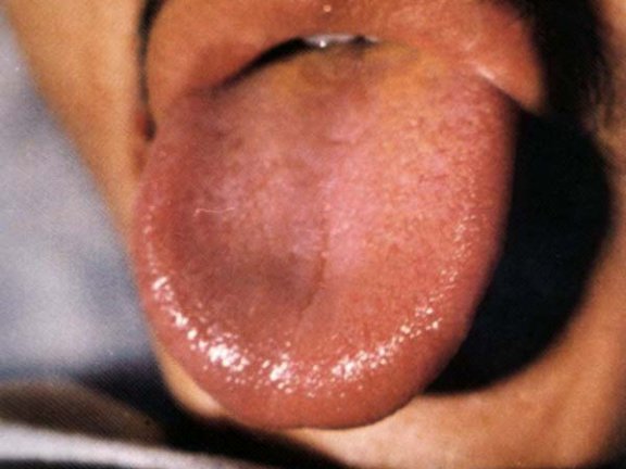 红舌黄白滑腻苔