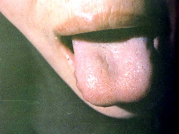 淡紫齿痕舌薄白滑苔