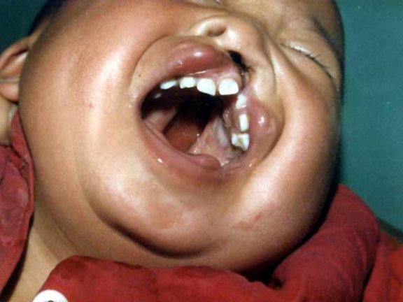 中医望口与唇之兔唇