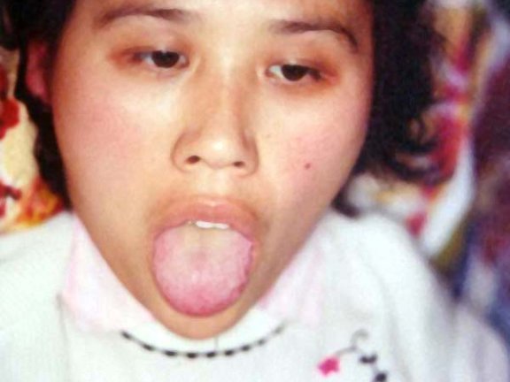 中医望神之面白颧红