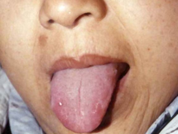 中医望鼻之鼻黄色浊