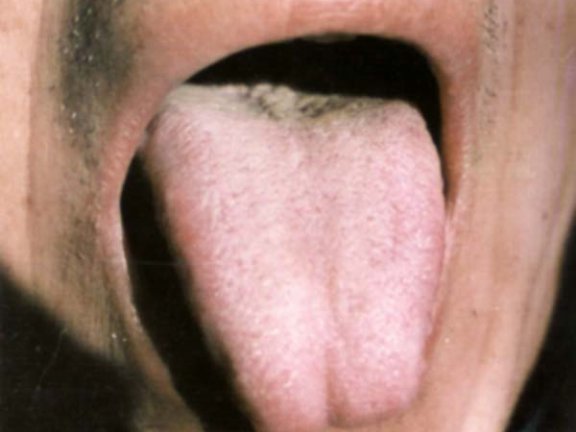 淡红舌白滑根灰苔