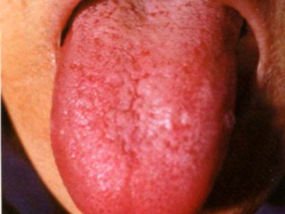 红绛舌白花腻苔