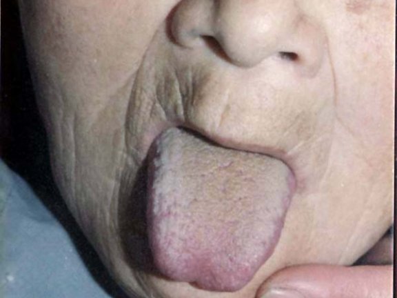 中医望色之面青灰