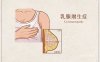 乳腺增生怎么治疗最好的方法 乳腺增生怎么治疗最好